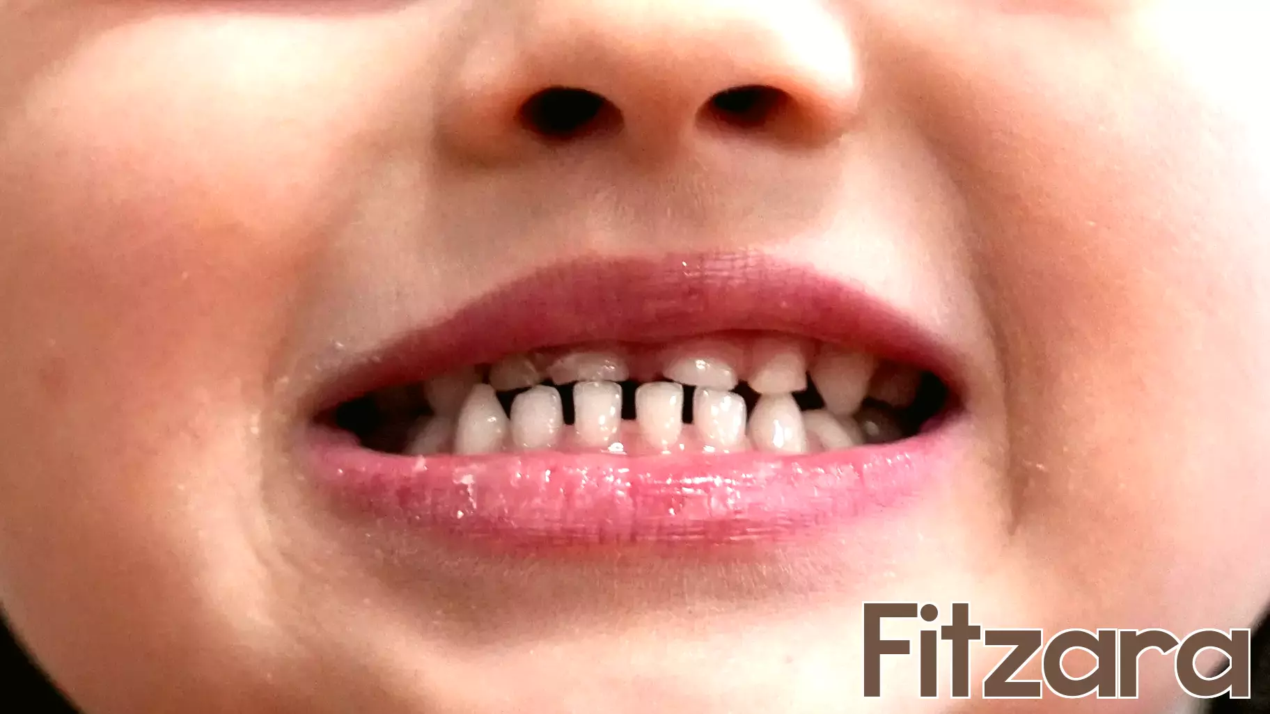 FDA Imposes Restrictions on Fluoride Supplements for Children Due to Health Concerns