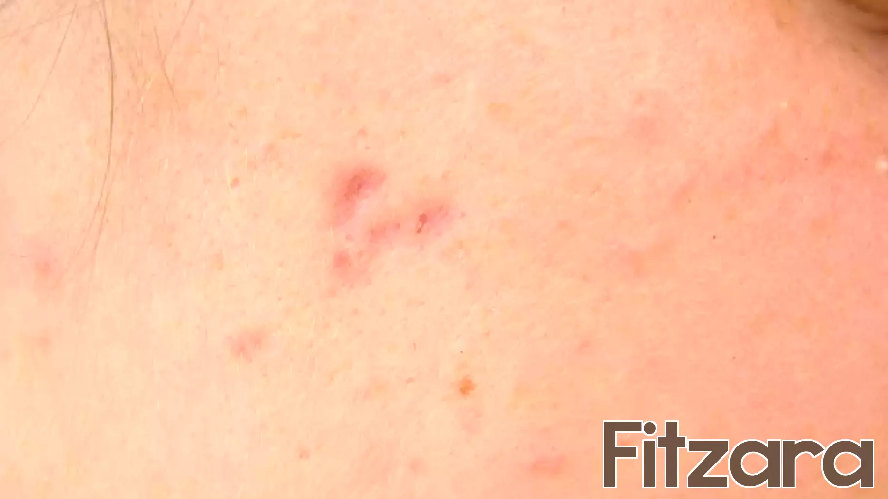 Study finds acne scarring linked to mental health impacts; Doctors urge early treatment