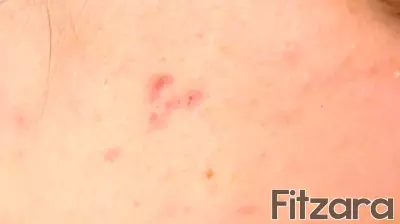 Study finds acne scarring linked to mental health impacts; Doctors urge early treatment