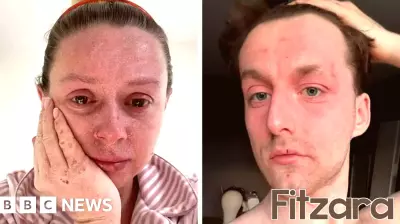 TSW amassing over a billion views on TikTok alone. These personal videos have created a global community of patients who feel abandoned by conventional medicine, often reporting that doctors dismiss their severe symptoms as a simple eczema flare.